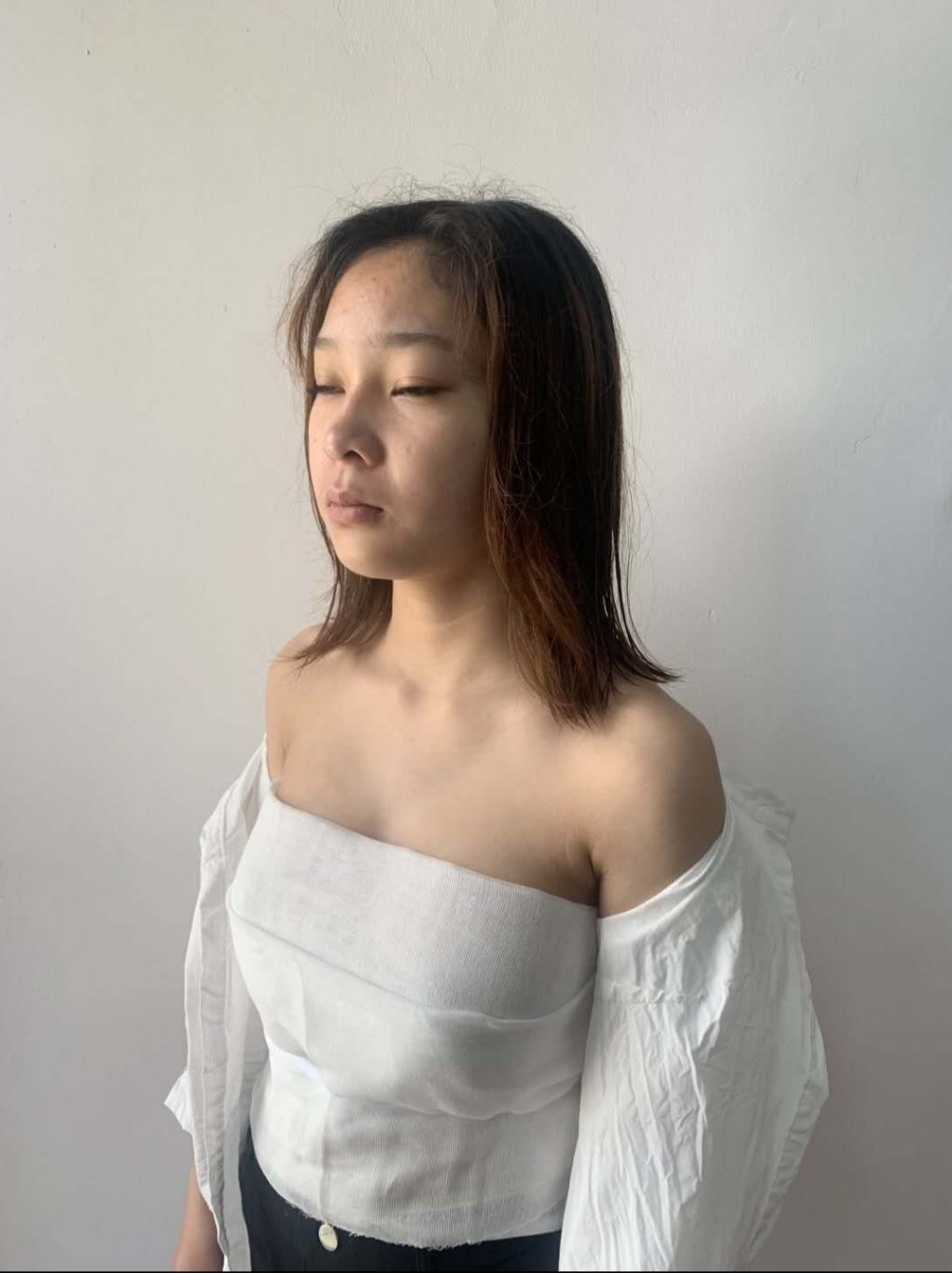 【自体脂肪丰胸术后5天】