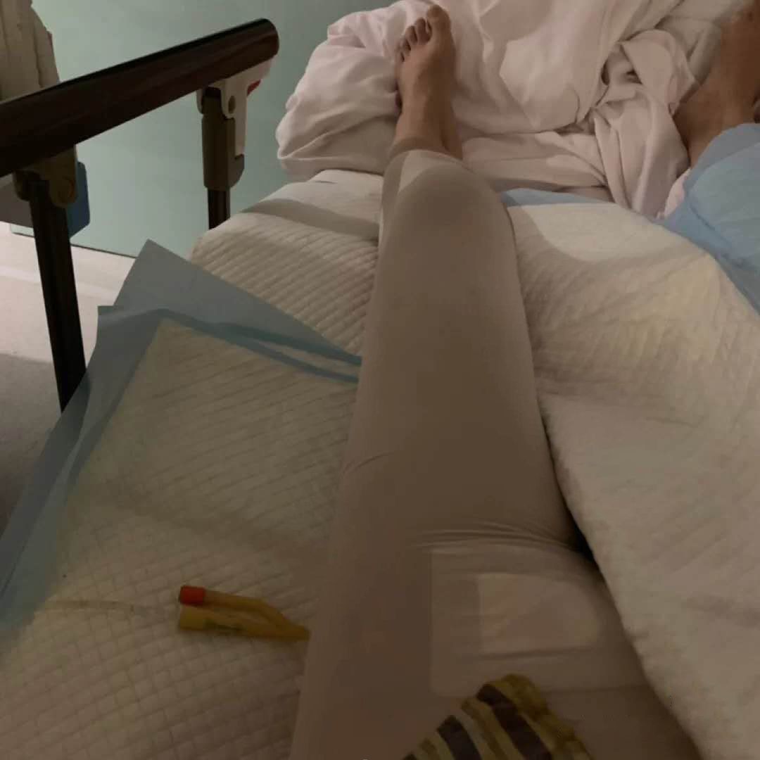 【沈阳汇美人大腿吸脂第1天】