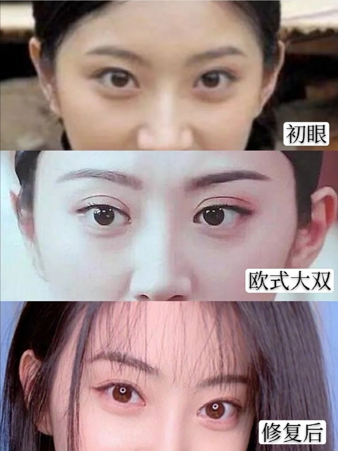 景甜欧式大双眼皮