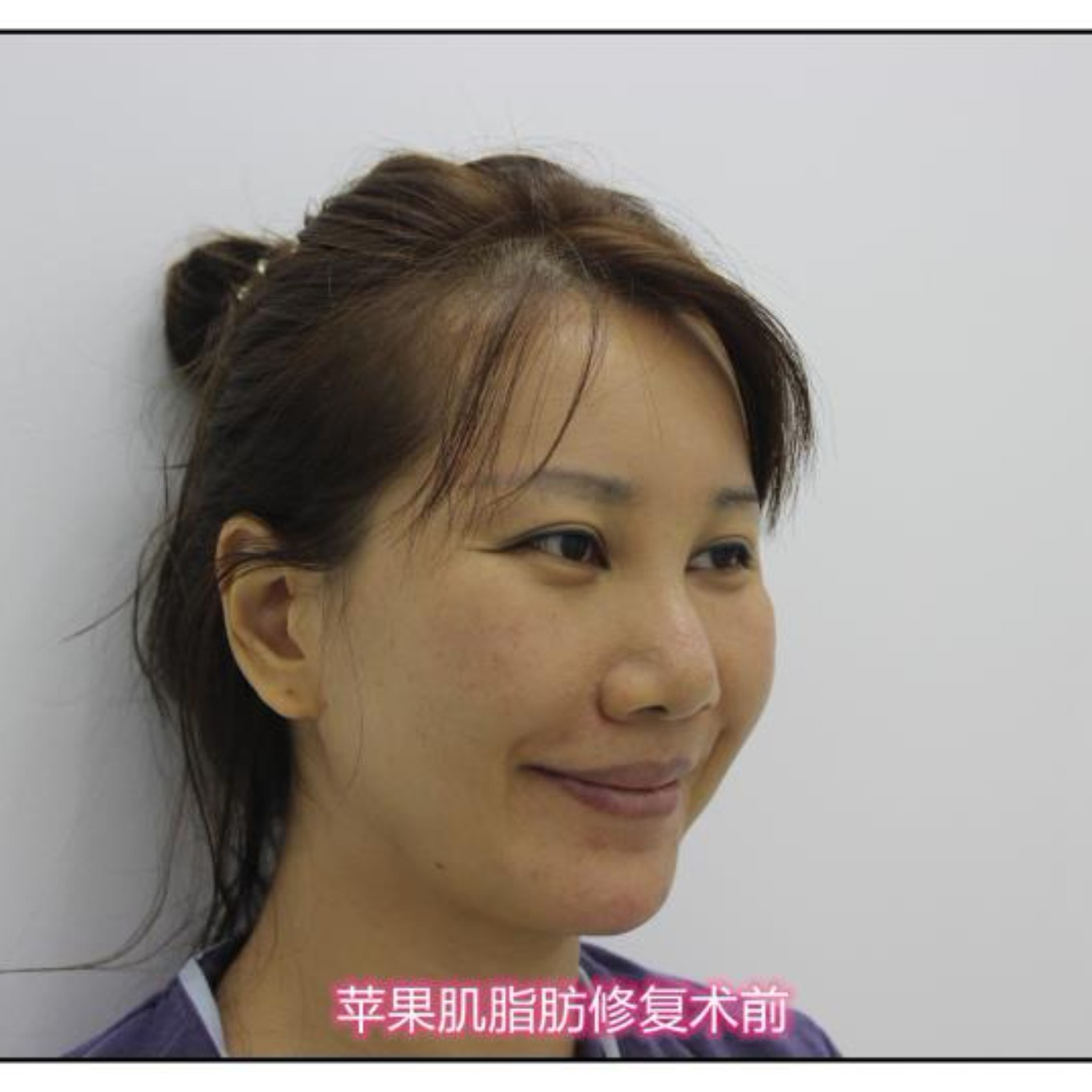 填充脂肪能维持多久_填充自己的脂肪_填充脂肪后吃什么成活率高