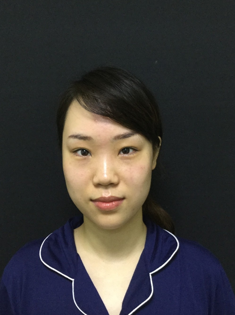 我的鼻小柱比较低,山根很平, 鼻子看起来比较塌,这_圈子-新氧美容整形