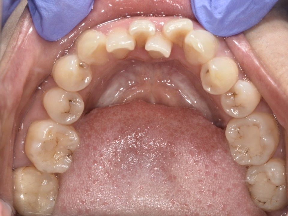 自锁托槽矫正进口陶瓷自锁托槽61简单版61牙齿排列不齐61连锁