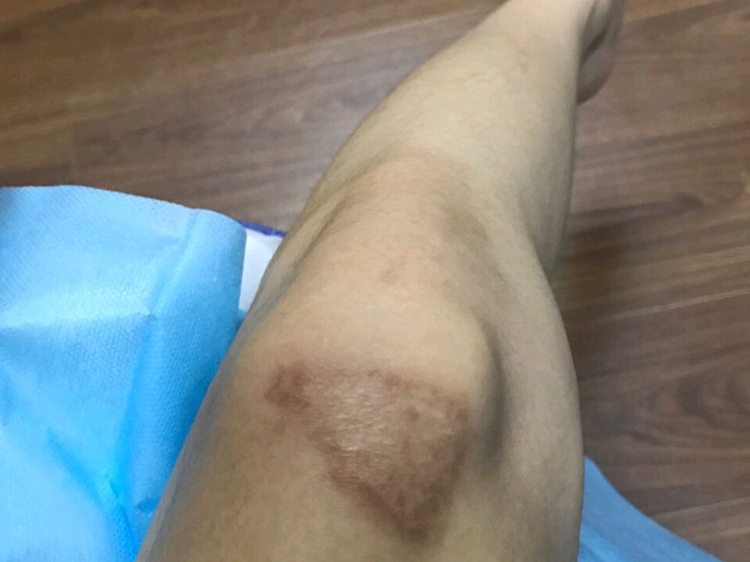 我膝盖摔伤,掉完痂皮后,就开始涂各种疤痕膏,还有膏