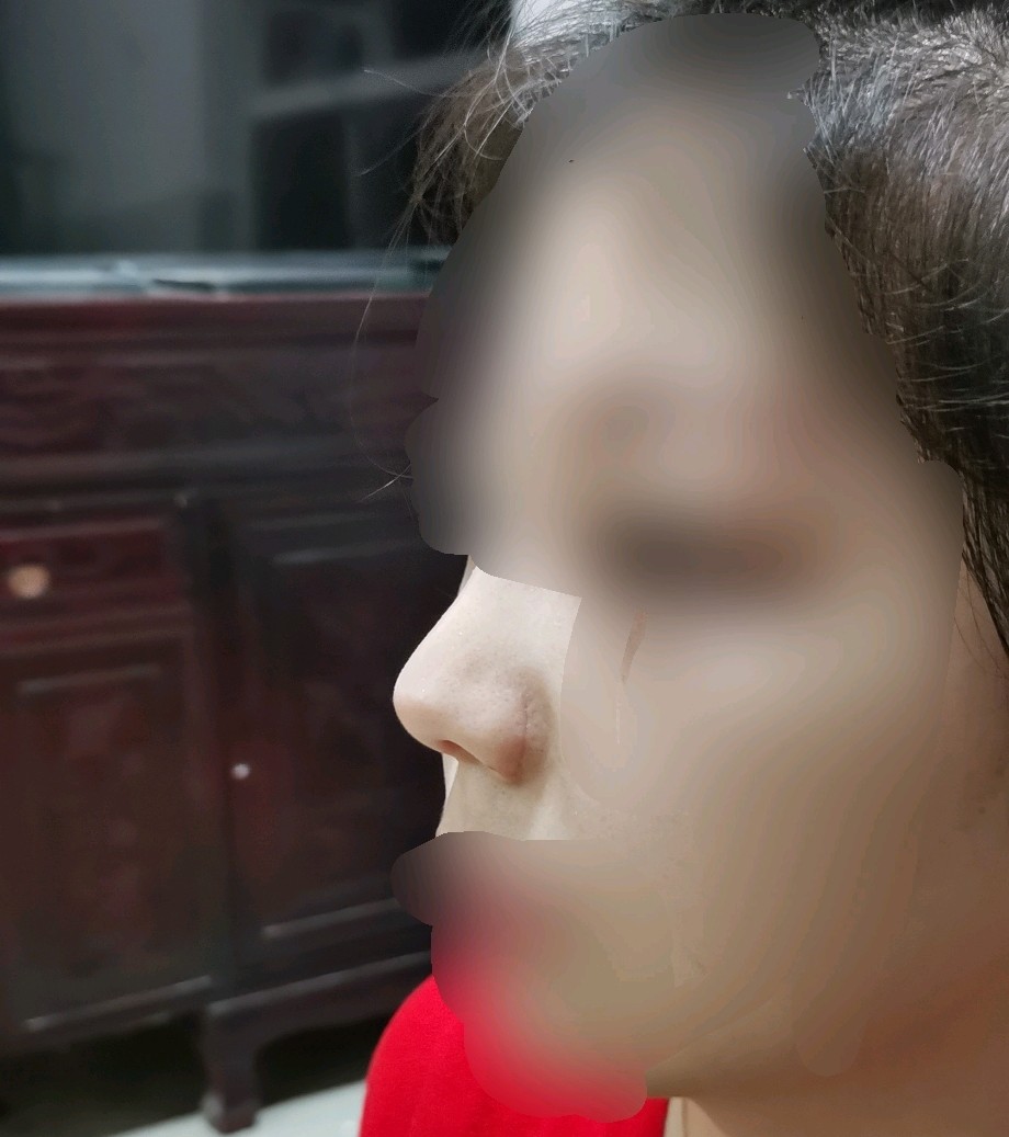 鼻部多项外切鼻翼一边有增生一边疤痕凹陷十分明显都是化完妆的样子这
