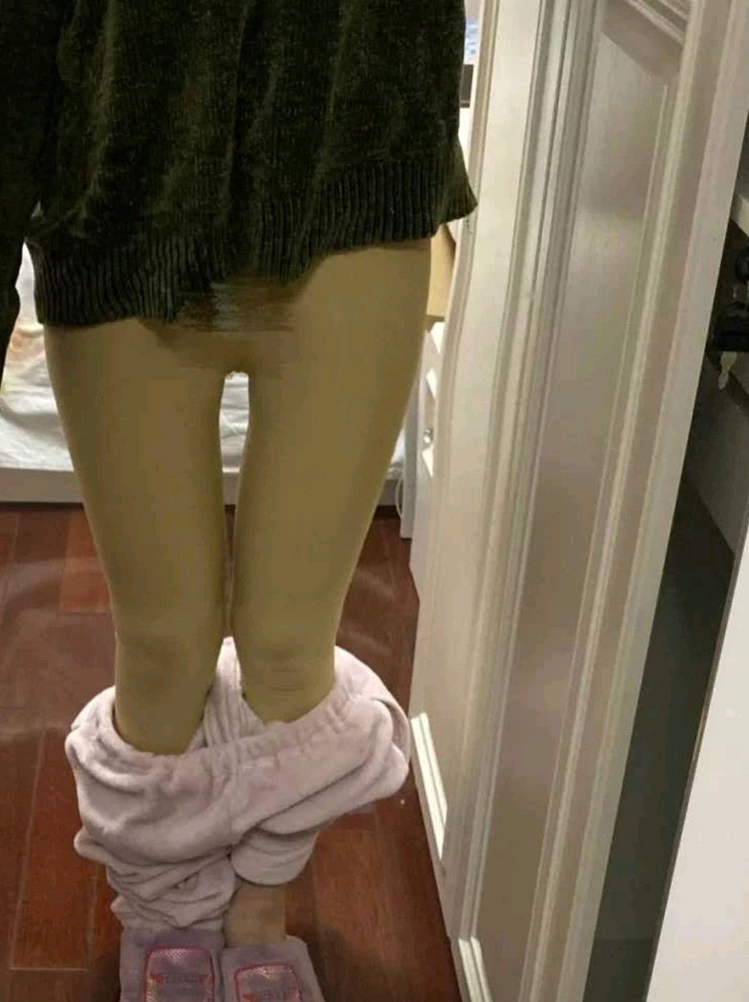 【沈阳汇美人大腿吸脂术后第45天】