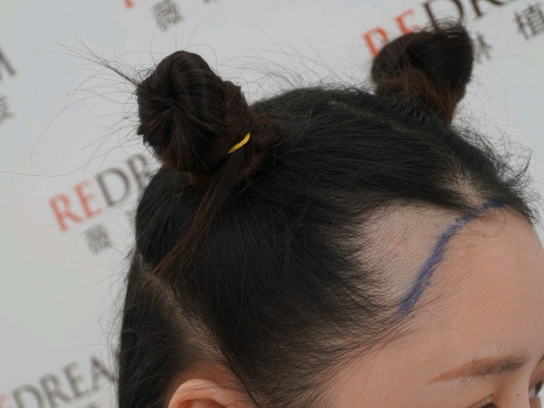 拯救坑坑洼洼的发际线,女生也要当心m字秃!