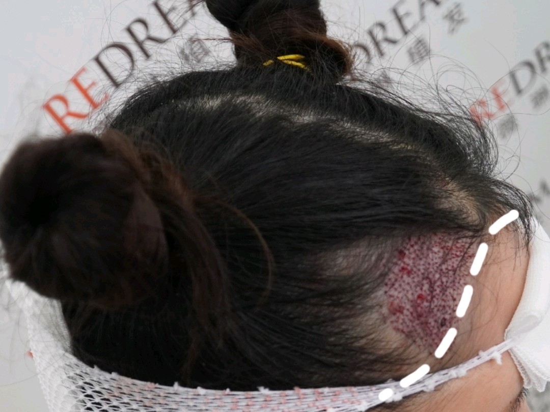 拯救坑坑洼洼的发际线女生也要当心m字秃