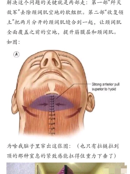 什么是双下巴肌肉捆绑