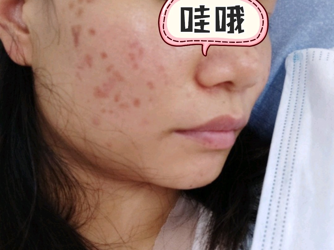 点阵激光第三天