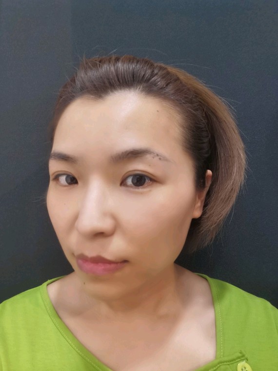 热玛吉第四代过了30感觉自己整个面部轮廓不清晰了_圈子-新氧美容