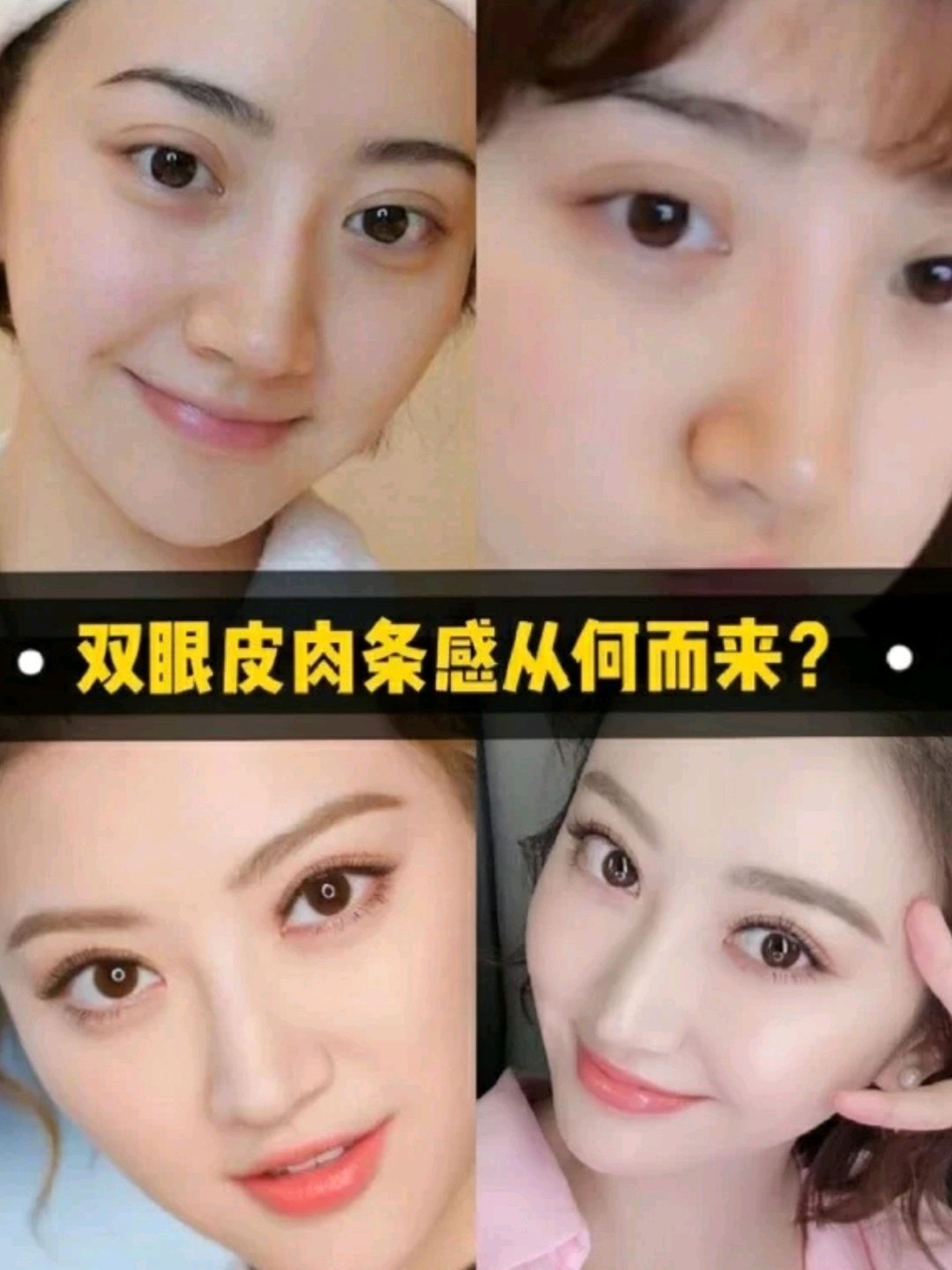 96景甜双眼皮去掉肉条感后美了好几倍6015所以,整双眼_圈子
