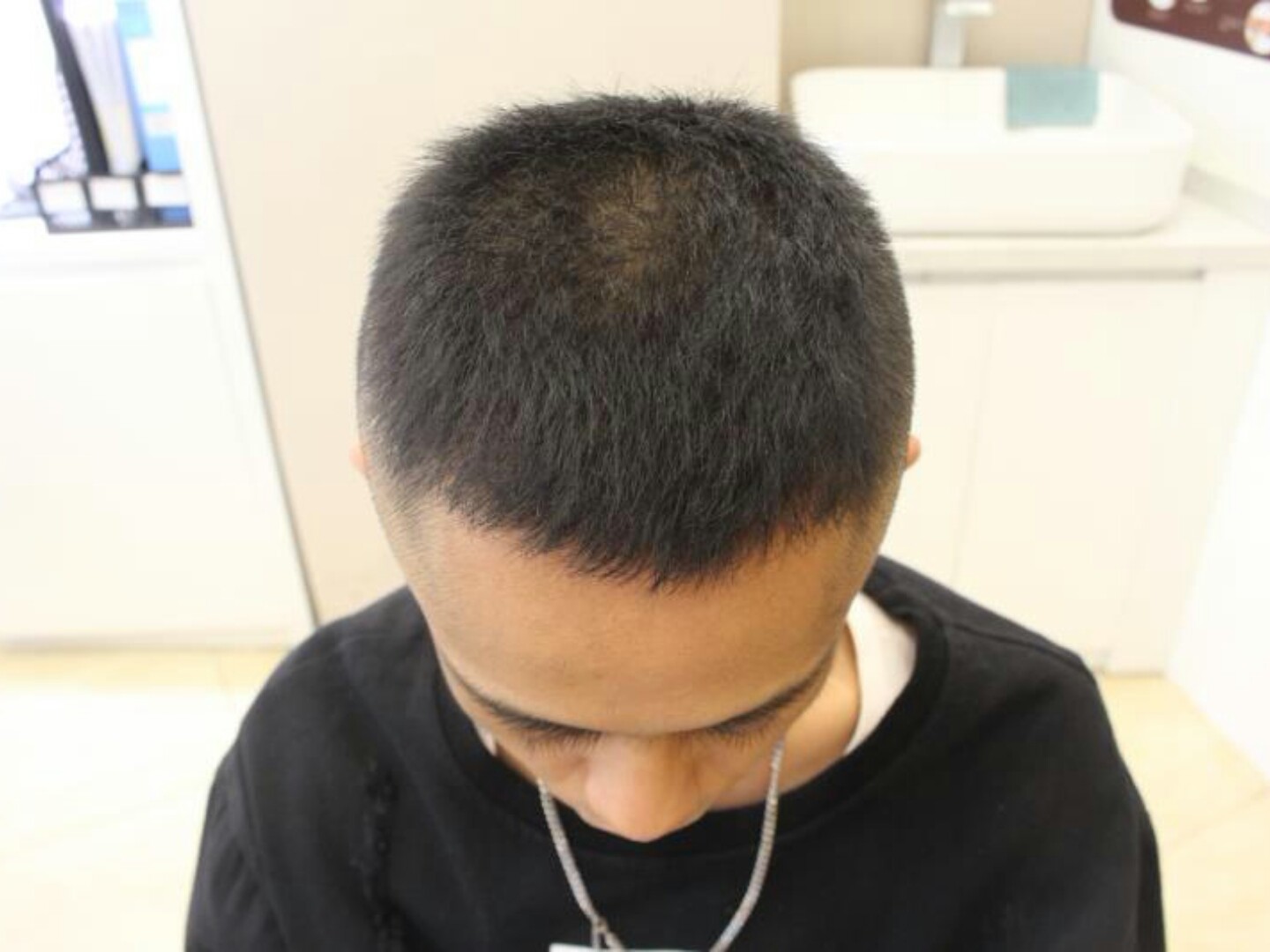 秃秃的鬓角真的很显老,从我的经历来看深有体会,植发_圈子-新氧美容