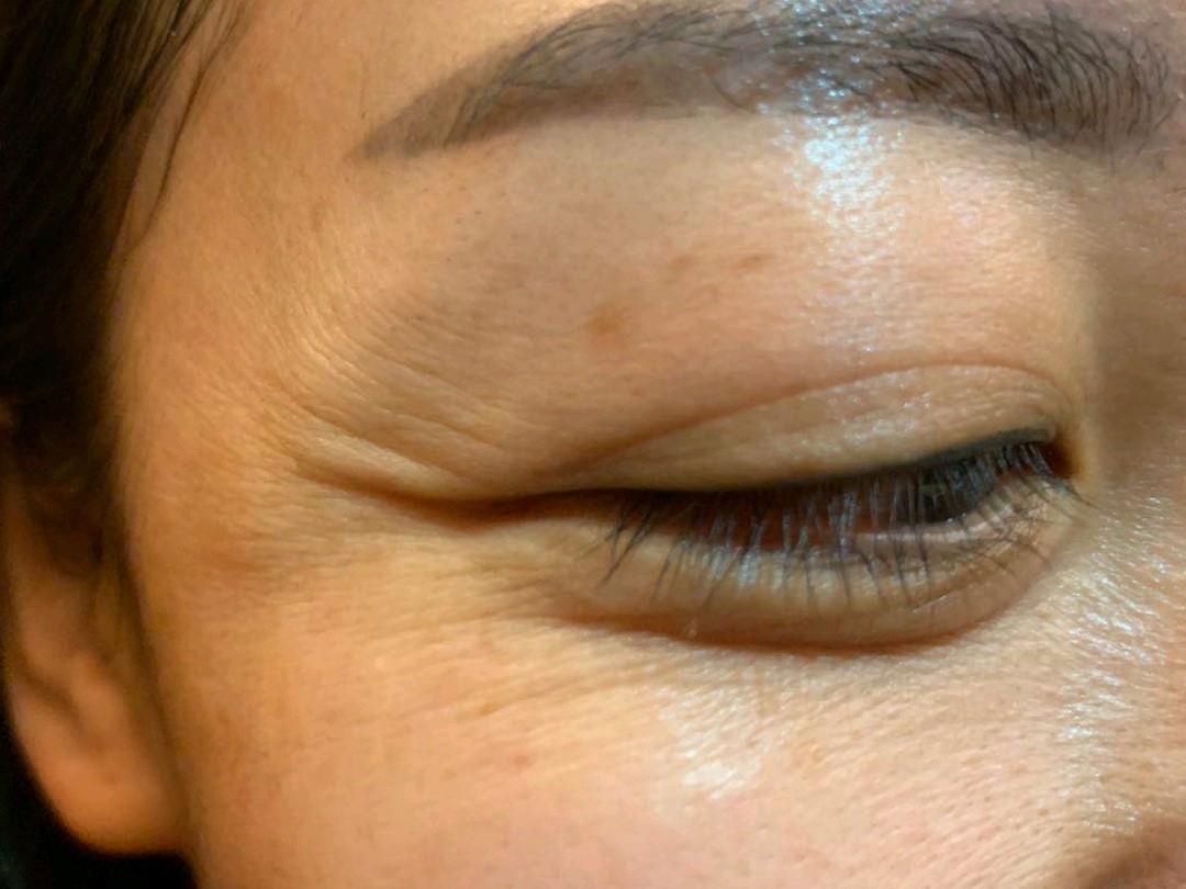 我的鱼尾纹被鄙视了!眼角皱纹真可怕,遮瑕膏都遮盖不_圈子-新氧美容整