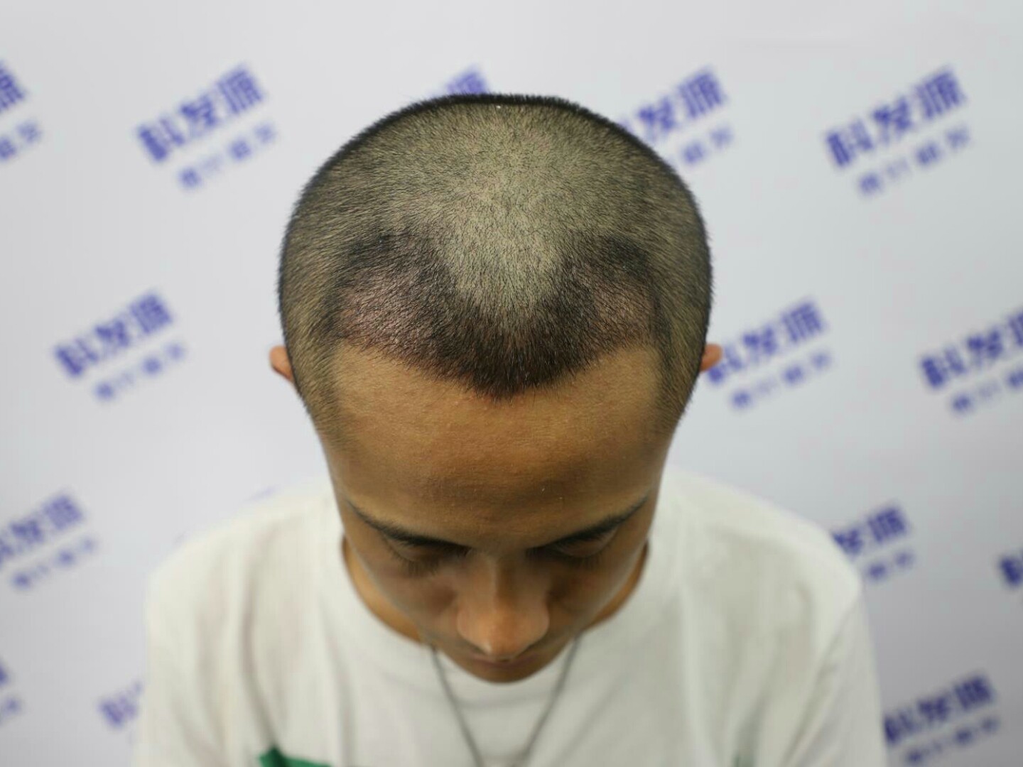 秃秃的鬓角真的很显老,从我的经历来看深有体会,植发_圈子-新氧美容