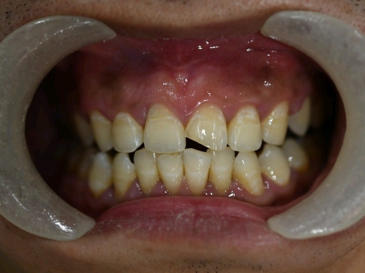 牙龈凹陷怎么回事图片