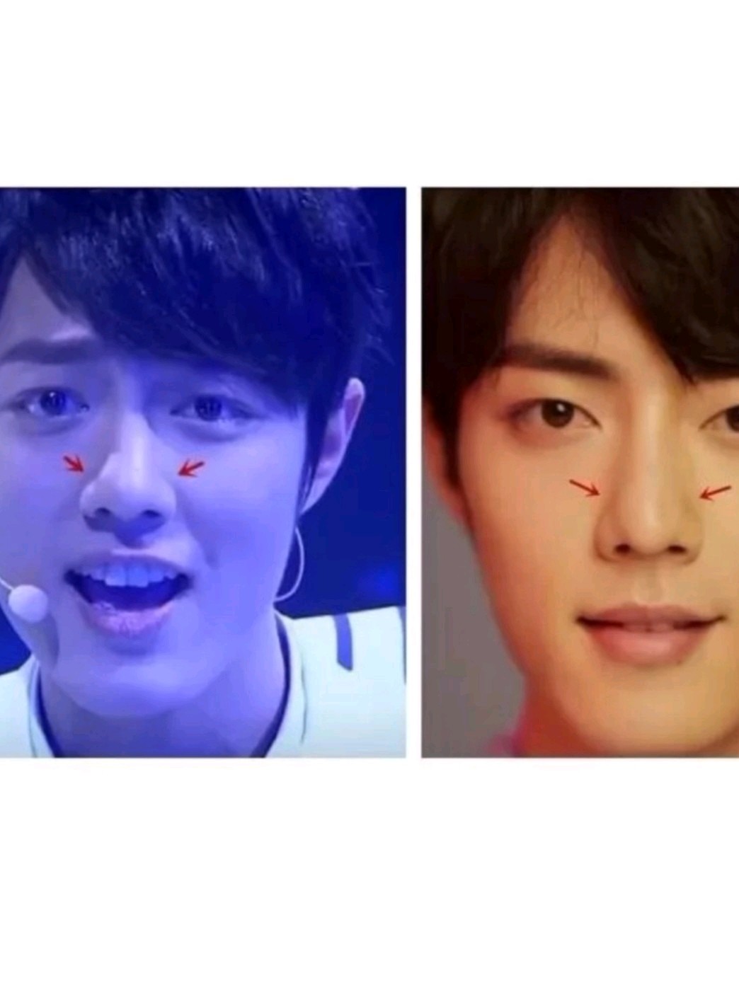 王一博,仰头的角度看鼻翼疤痕如此明显!