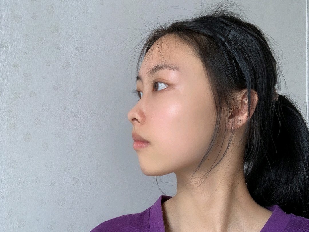 鼻梁低,鼻尖平,整_圈子-新氧美容整形