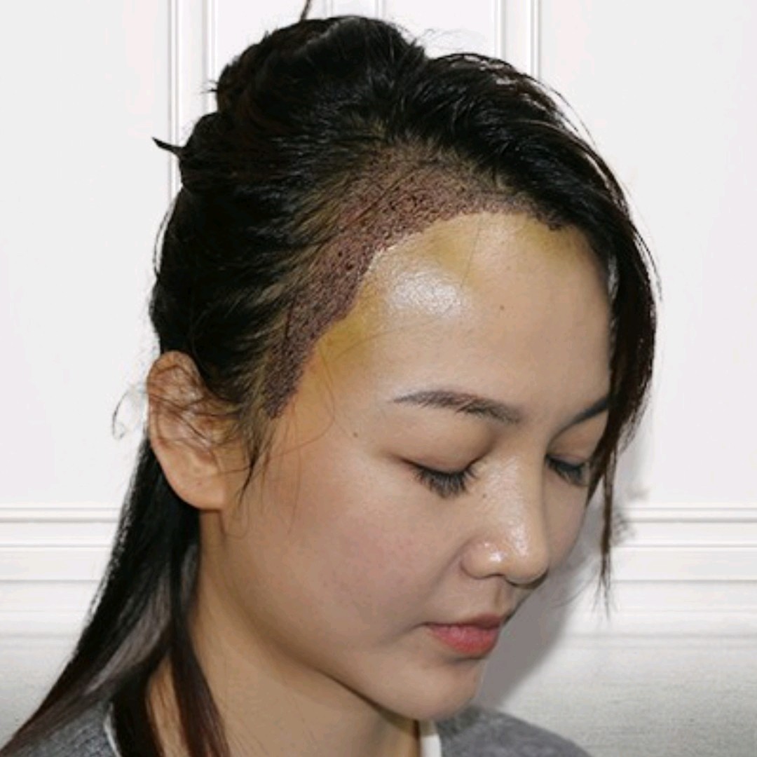 植发.三天,三天了,终于不用服用药物,种植的感觉也不明显了,开心.