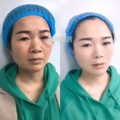 医生 社区 医美百科 整形有风险决策需谨慎 登录 ☀️ 星韵桃花面