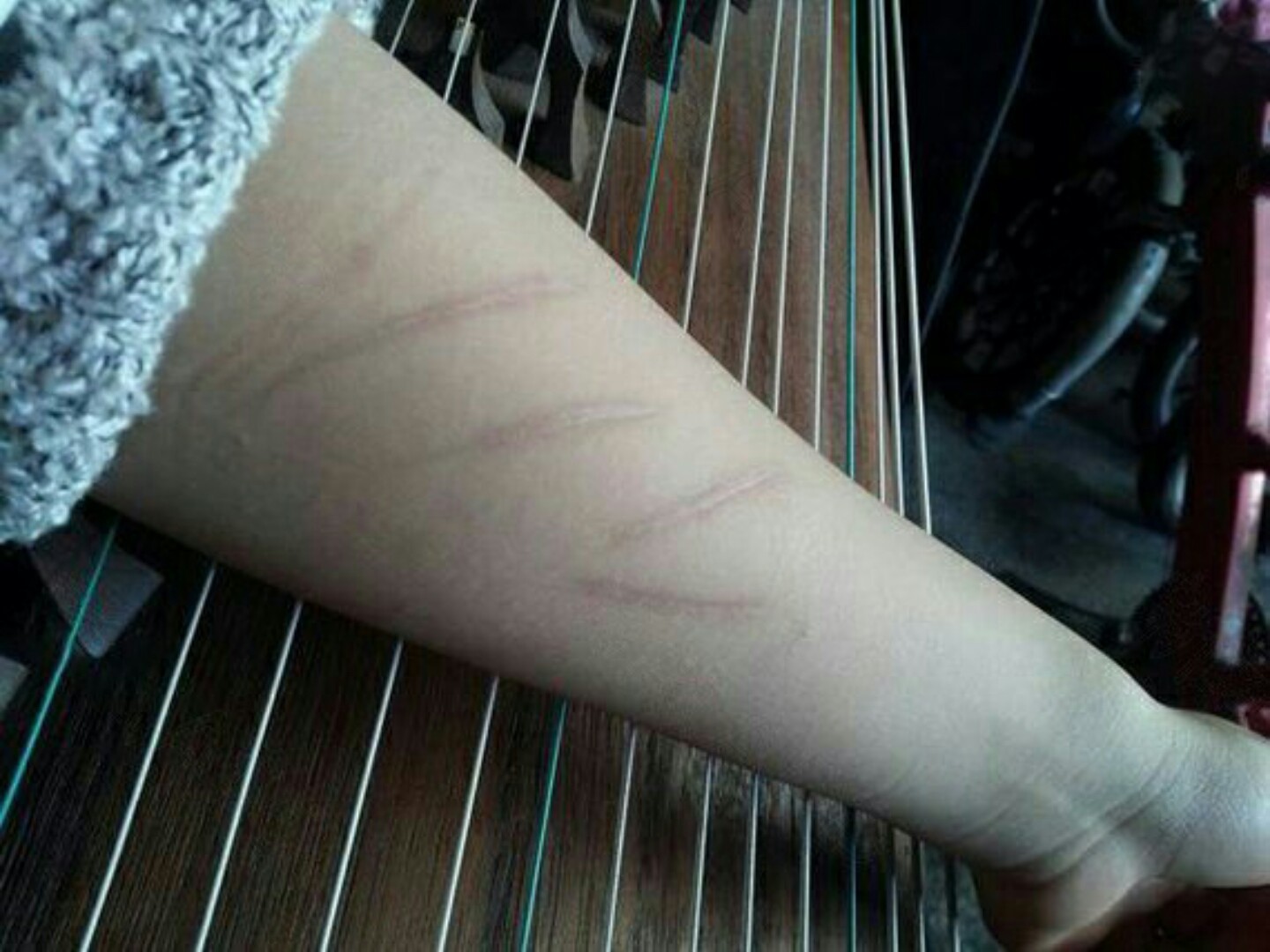 手上的疤痕是小时候顽皮自己弄到的,觉得很难看,我妈_圈子-新氧美容