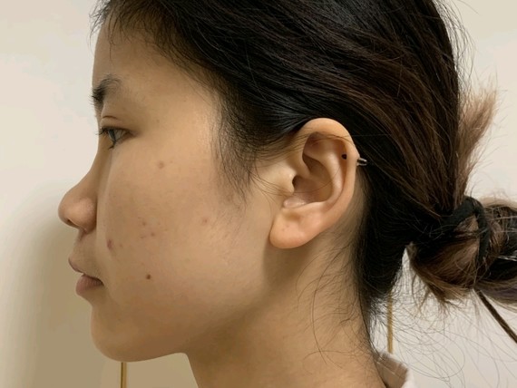 术前的我矮鼻梁,宽鼻翼,面部轮廓看起来不够立体,比_圈子-新氧美容