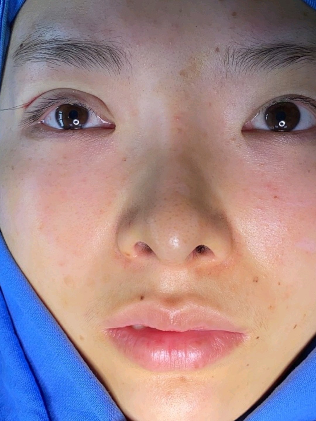 【埋线双眼皮分享】@杨璐