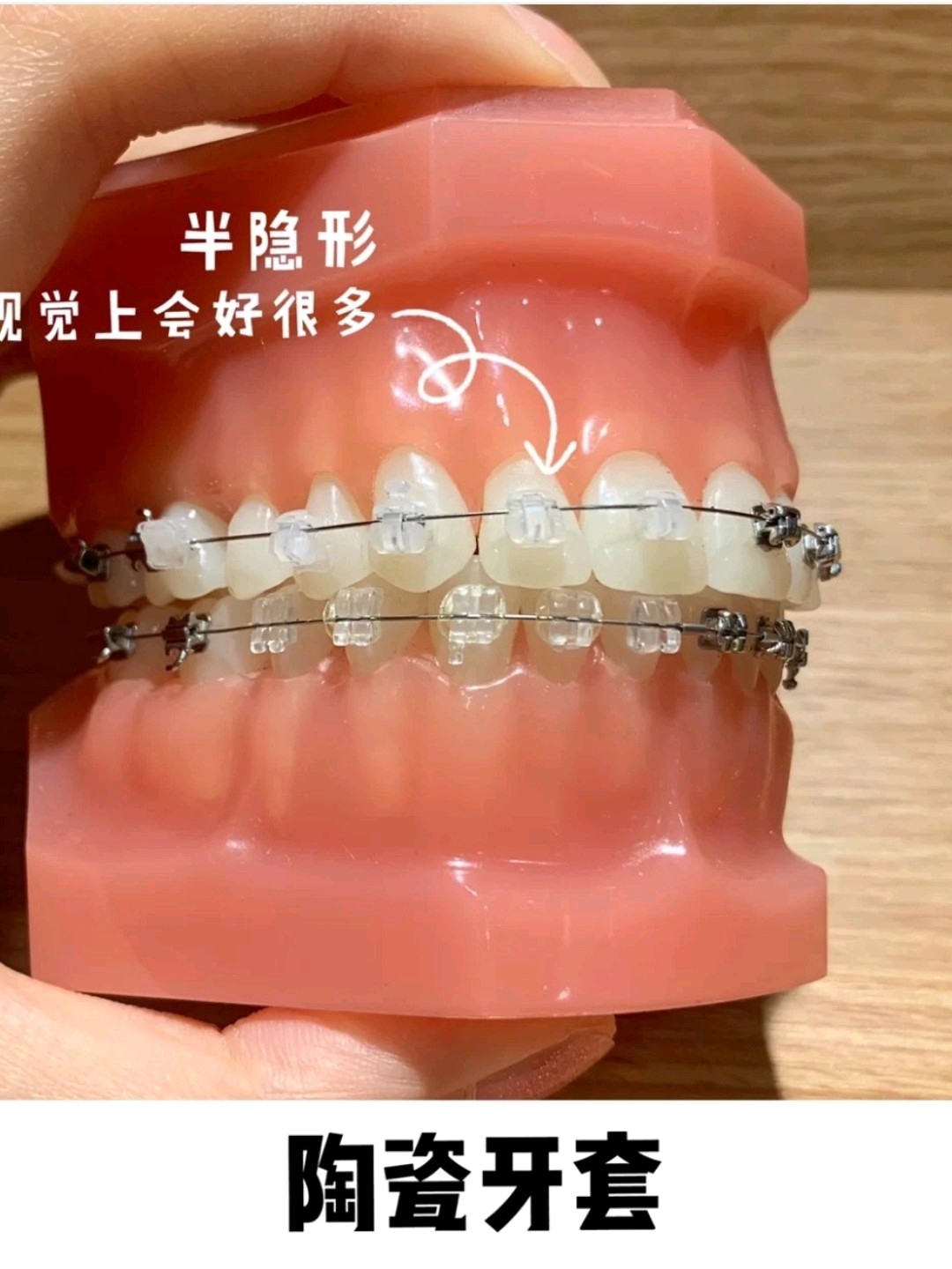 牙齿矫正|超全牙套挑选攻略日