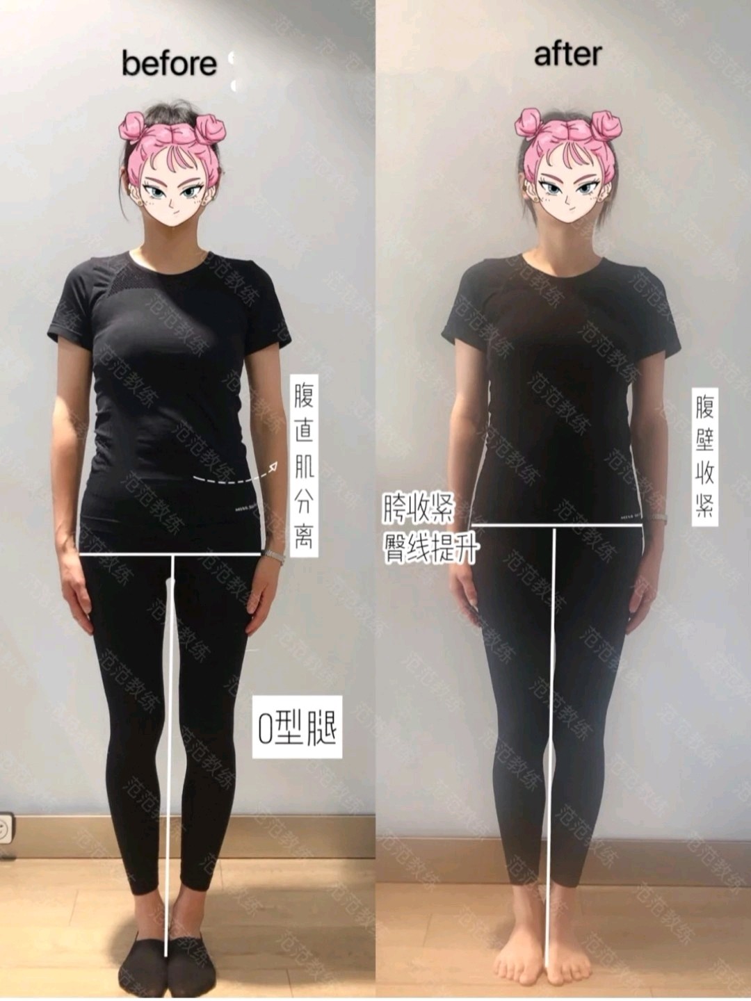 腿,大腿骨内旋,膝内翻,小腿骨相对外旋,脚踝不正,还有大小脸 2侧面观