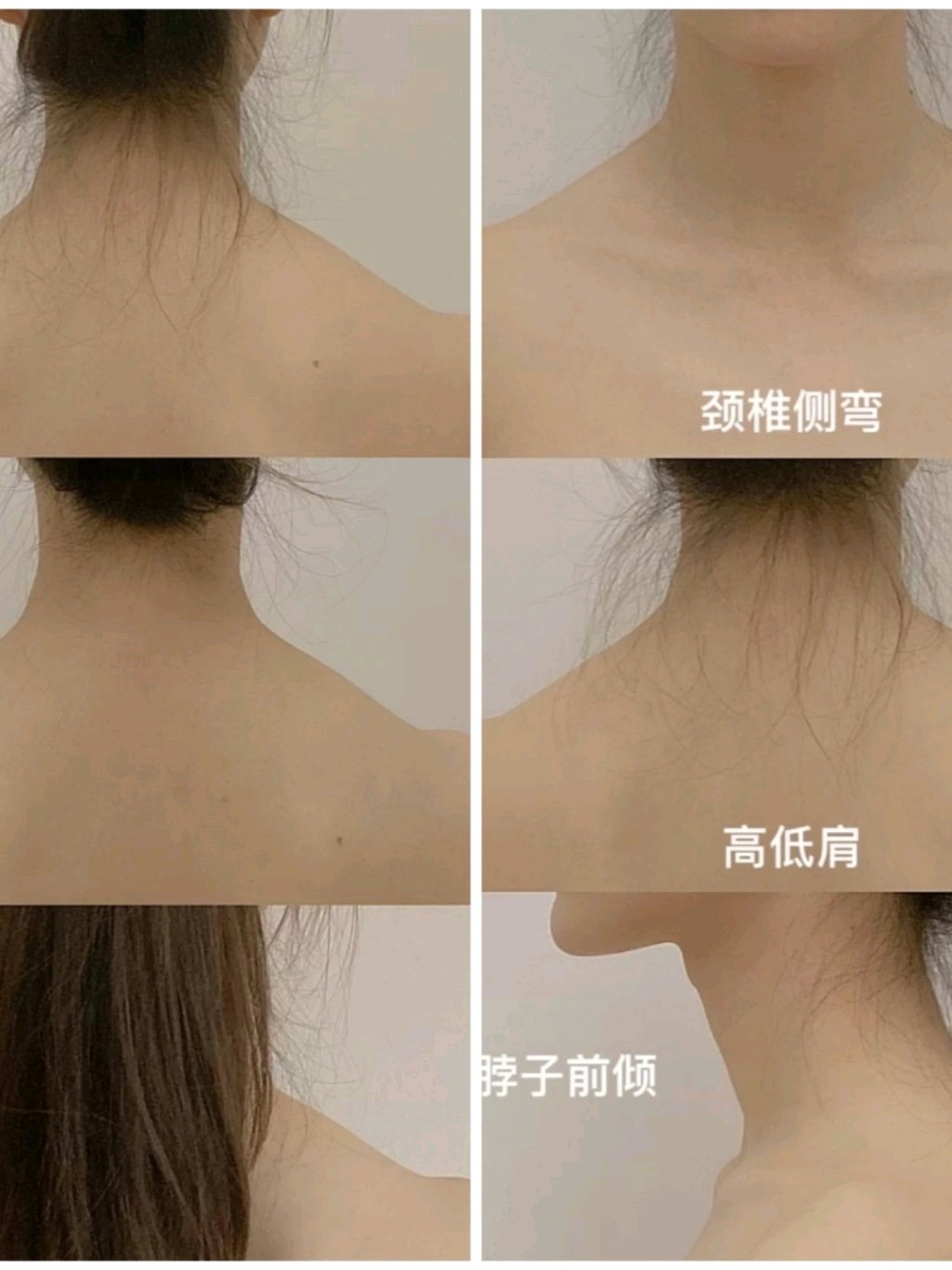 改善斜方肌对我这个真的有用吗?已经练了30多天了,_圈子-新氧美容整形
