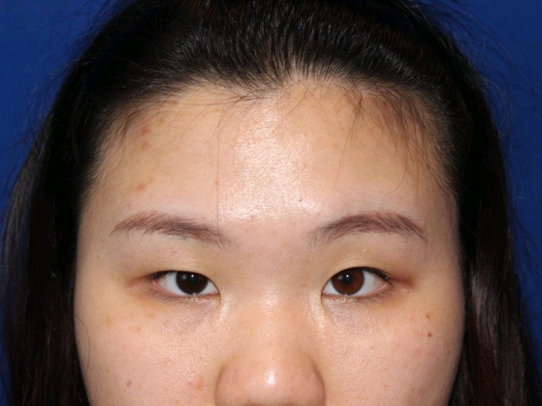 天生98单眼皮还大小眼,_圈子-新氧美容整形