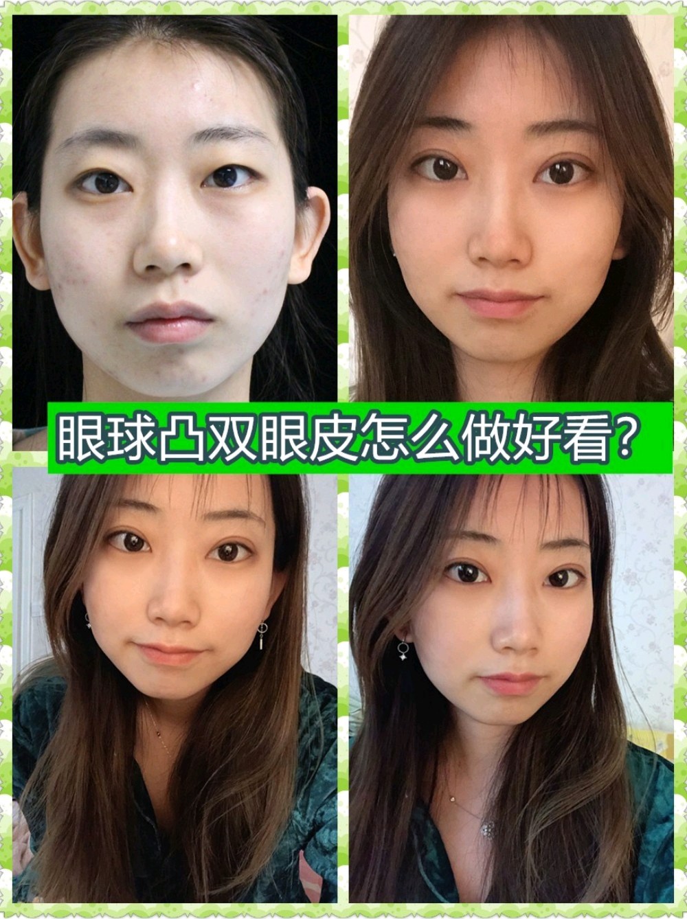 眼球凸雙眼皮怎麼做好看?