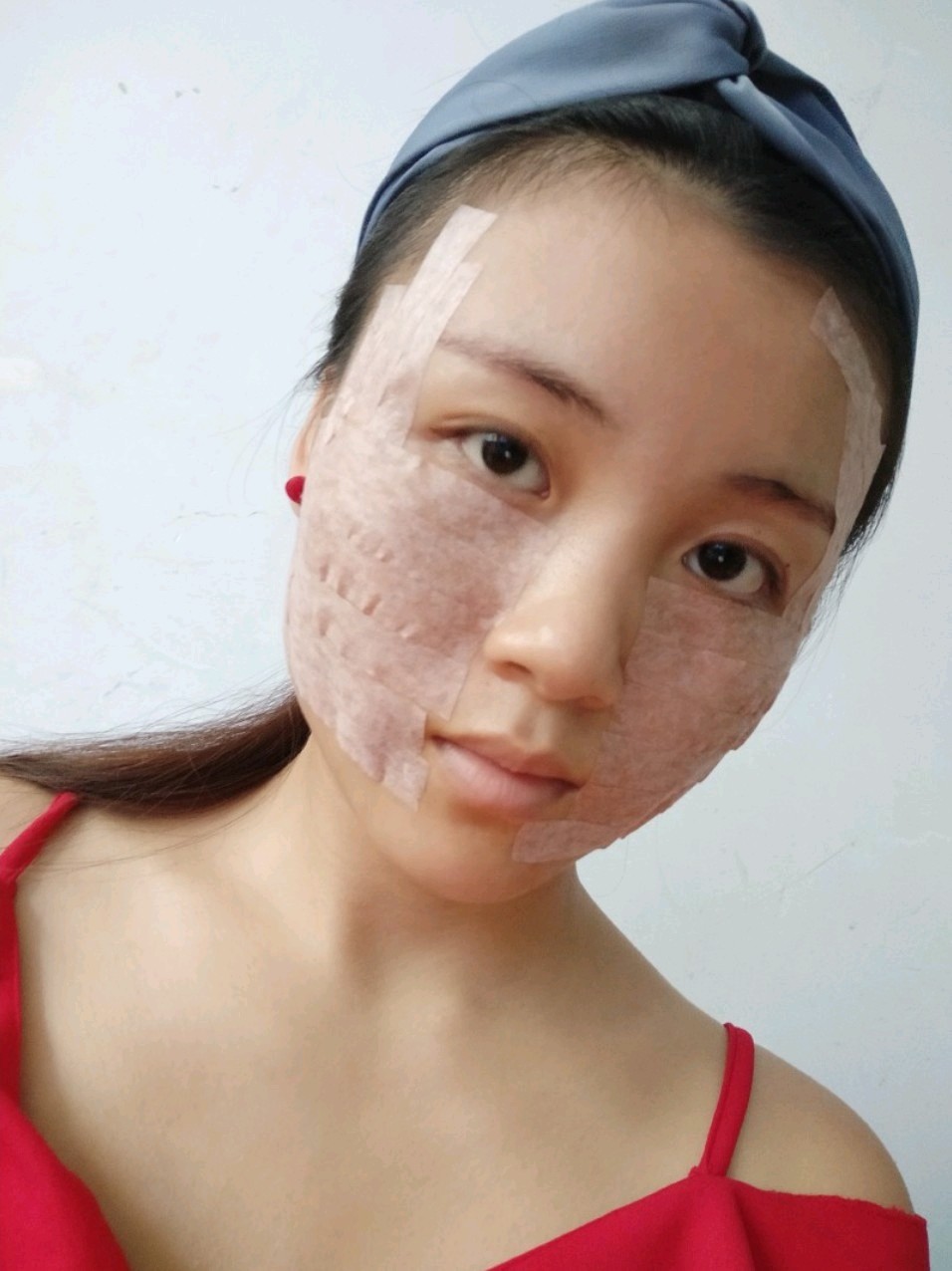 【哈尔滨诺依美】【全面部线雕】刚做完第2天,有点肿_圈子-新氧美容