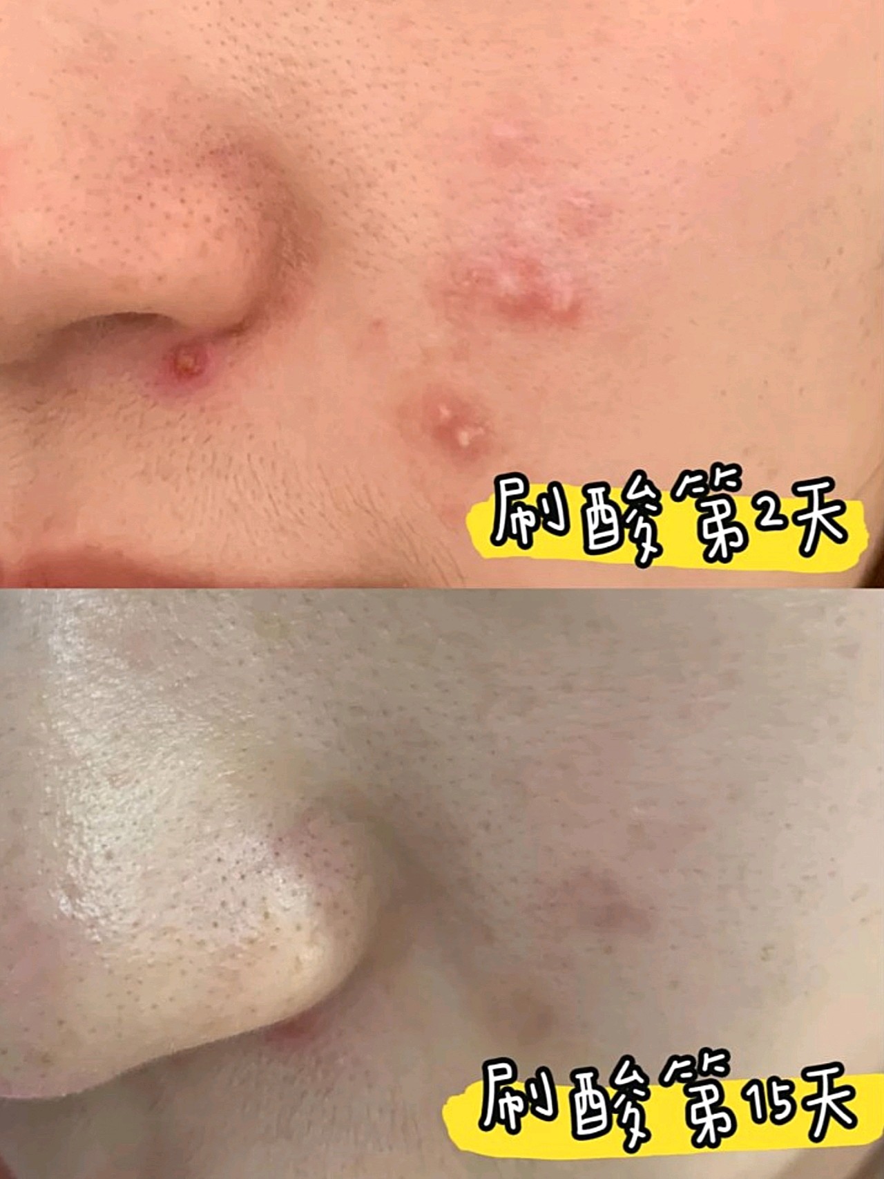 我的好皮肤可是刷了20天酸啊16怎样刷酸祛痘桥本环奈_圈子-新氧美容