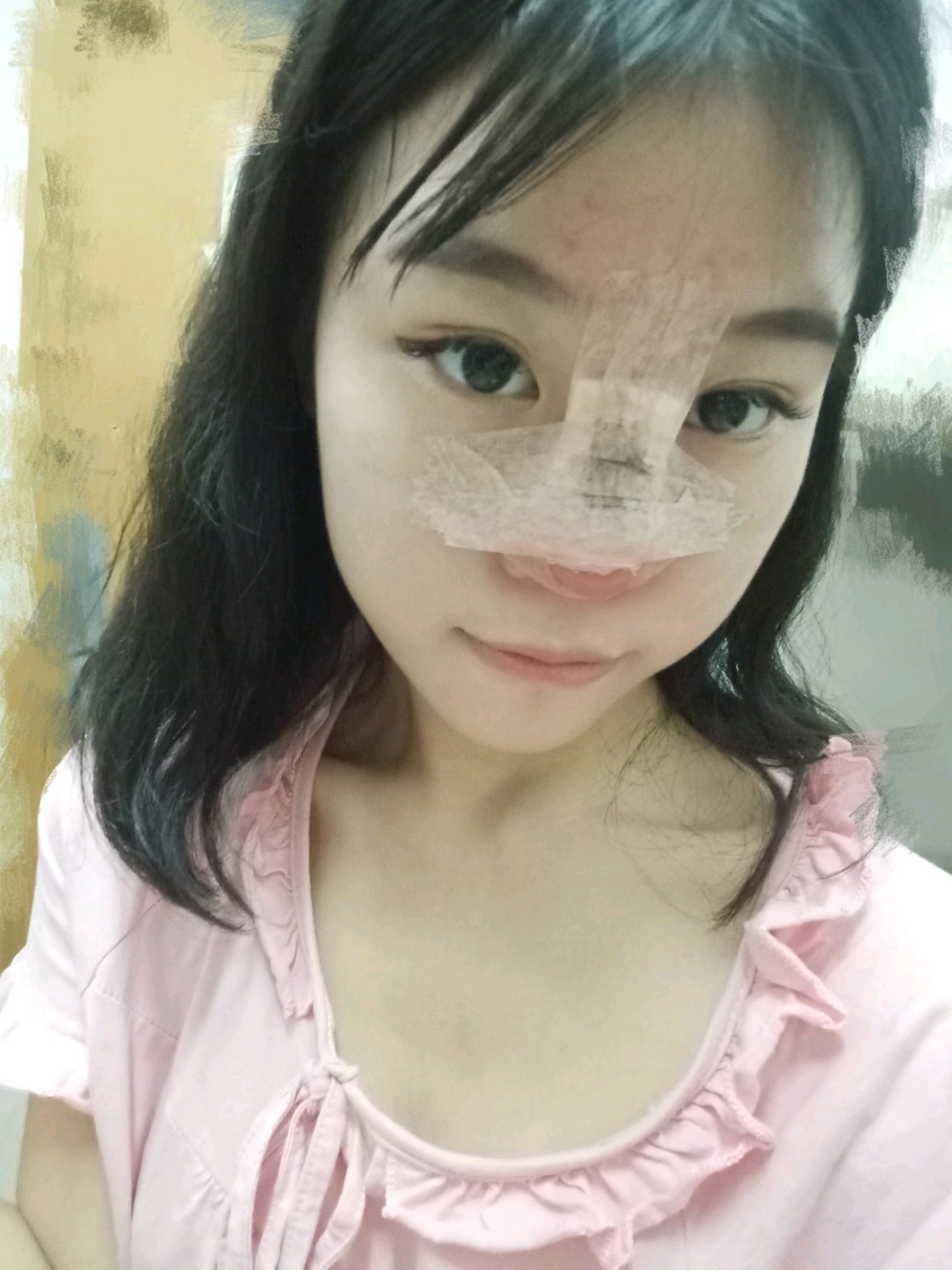 今天是隆鼻手术的第一天现在鼻子上粘着纱布可以看出鼻尖有点红手术