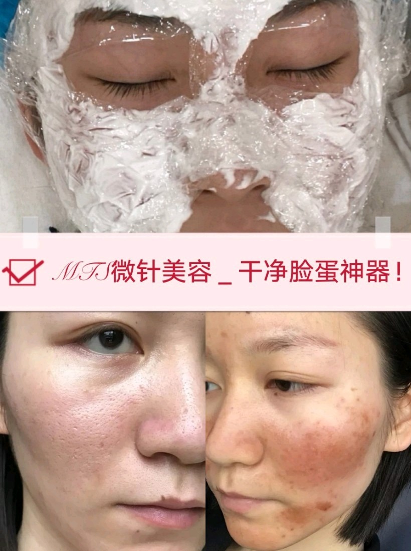 mts微针美容疗法9999mts微针美容疗法是现在一种_圈子-新氧美容