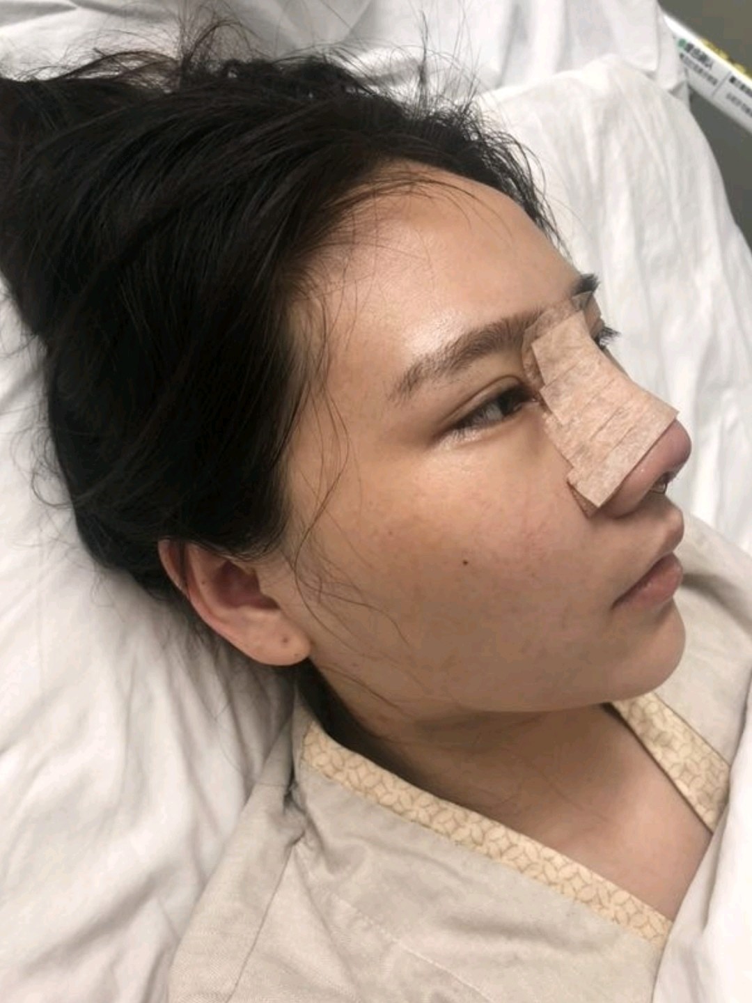 改造蒜头鼻的术后心得-想要到更远的地方欣赏美,想_圈子-新氧美容整形