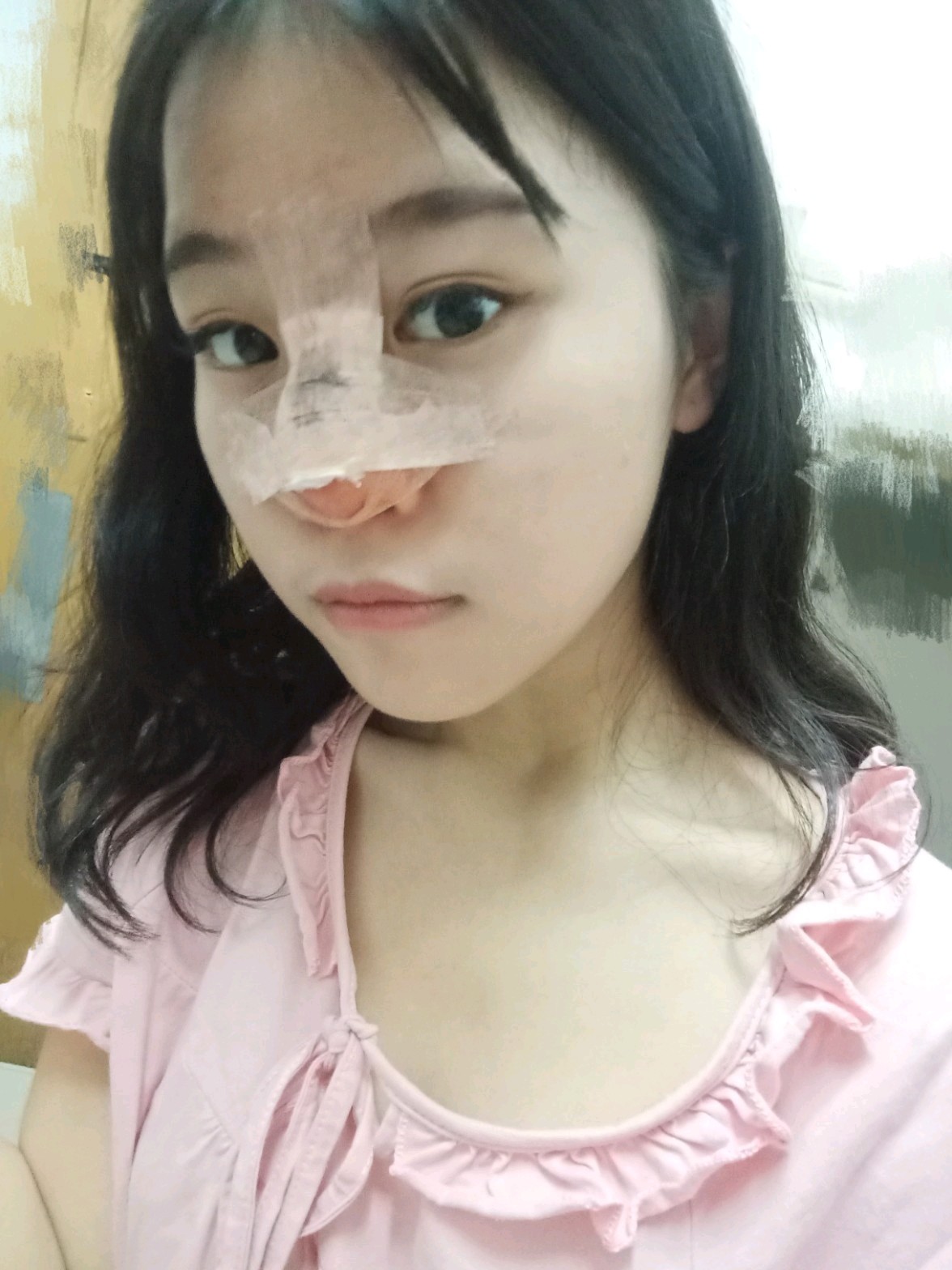 今天是隆鼻手术的第一天现在鼻子上粘着纱布可以看出鼻尖有点红手术