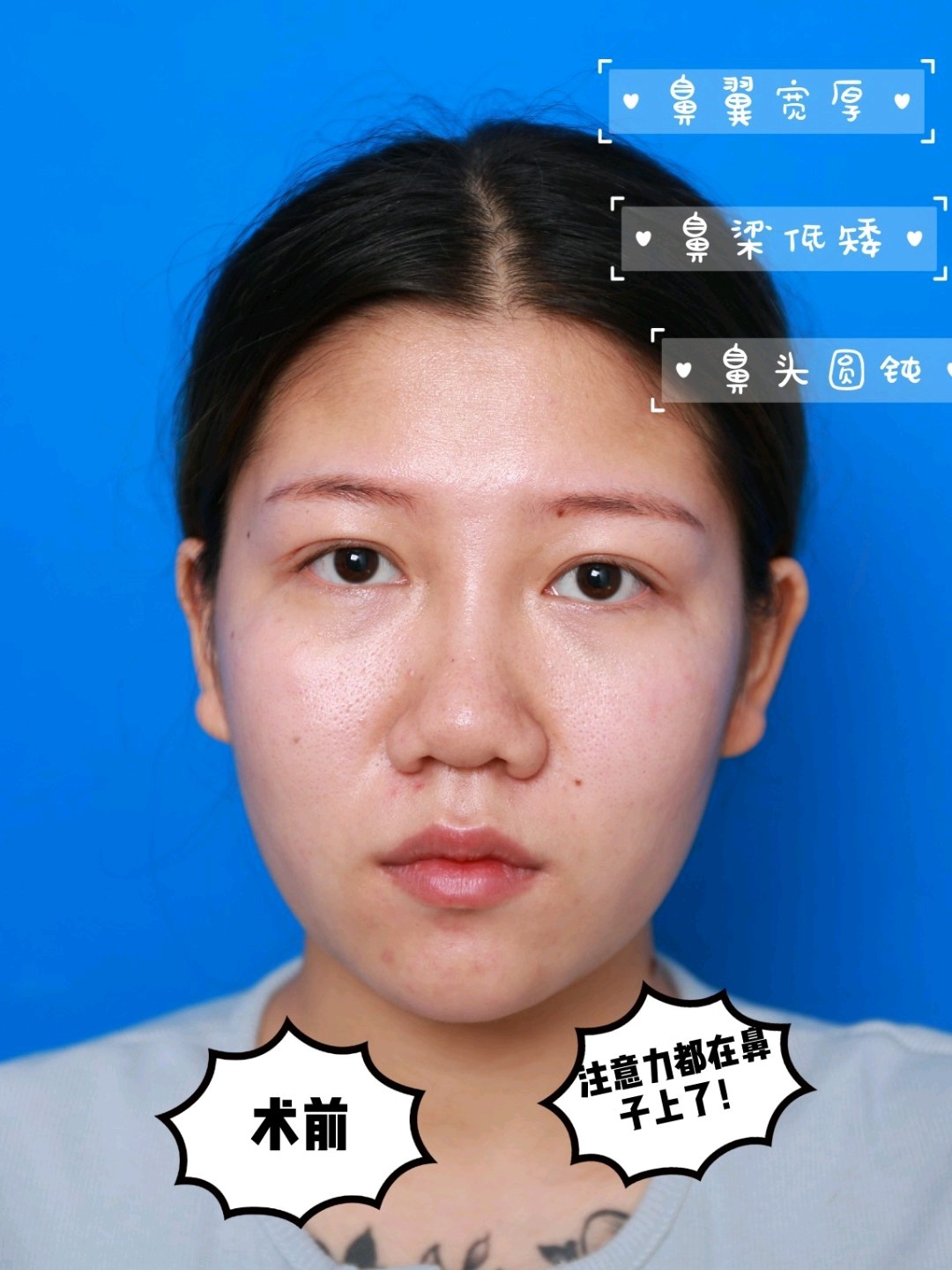 6015鼻子看起来很塌,也与你的鼻小柱过短有关,特别是_圈子-新氧
