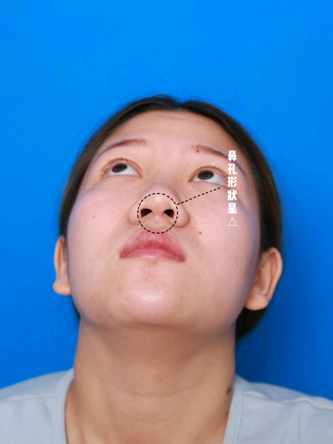 6015鼻子看起来很塌,也与你的鼻小柱过短有关,特别是_圈子-新氧