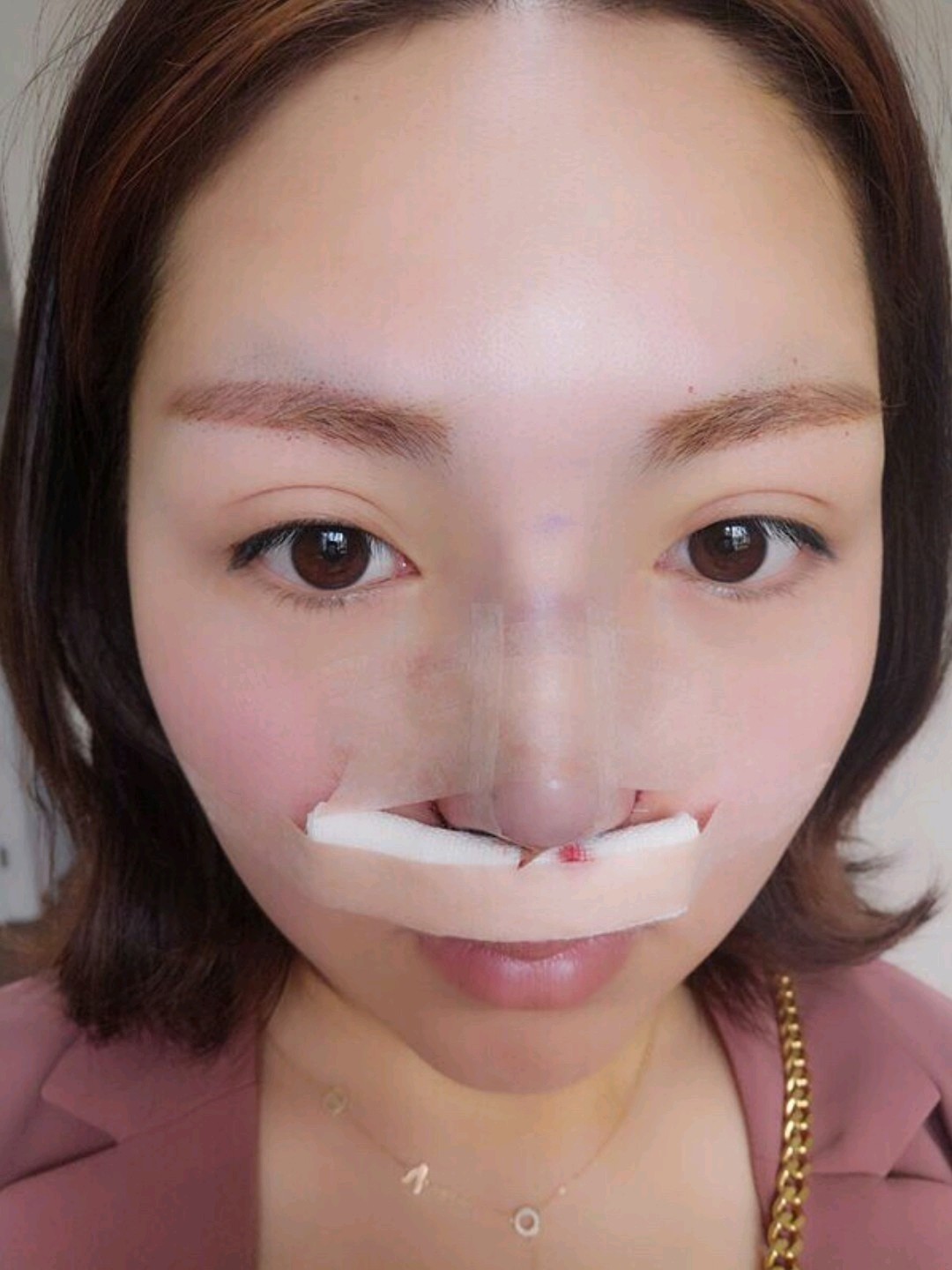 我鼻梁也不低,就是鼻头向下不好看,想做垫鼻尖手术,_圈子-新氧美容