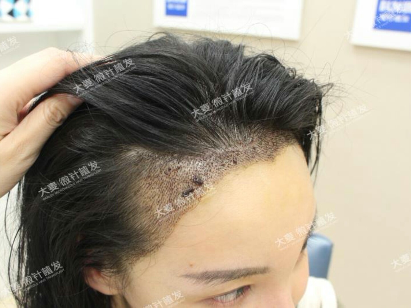 大麦微针植发术后7天:我是植发第三天的时候去过一下_圈子-新氧美容