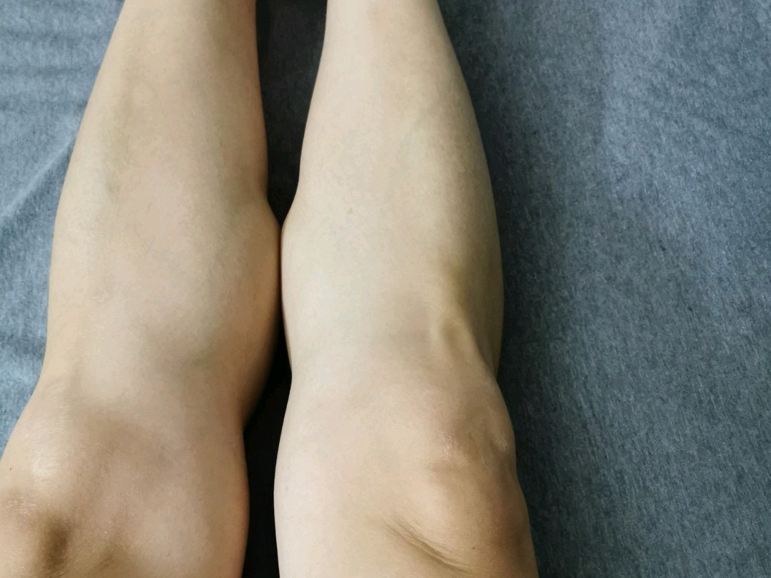 集美们,这样的运动员小腿得打多少针瘦腿针才能瘦下来_圈子-新氧美容