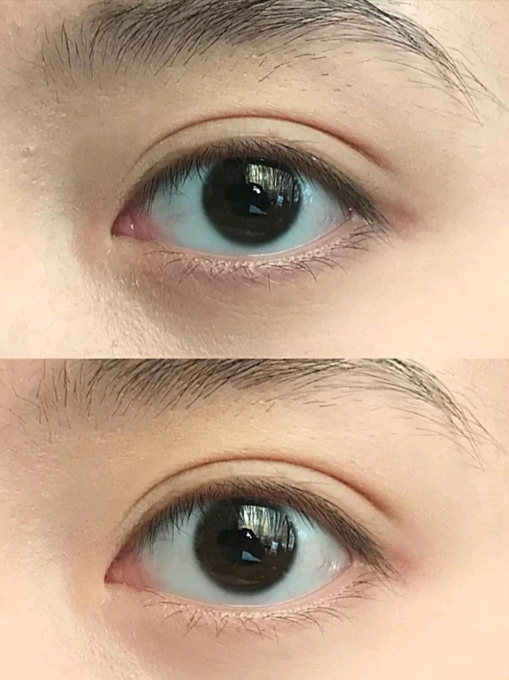 真的能徒手开眼角?7天对比原图直出|实测对比|附详_圈子-新氧美容整形