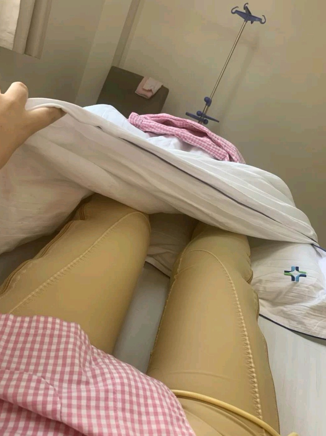 沈阳汇美人大腿吸脂术后2天