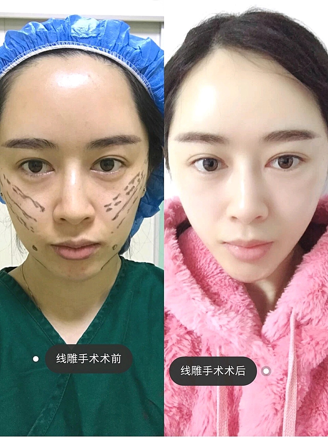 线雕手术