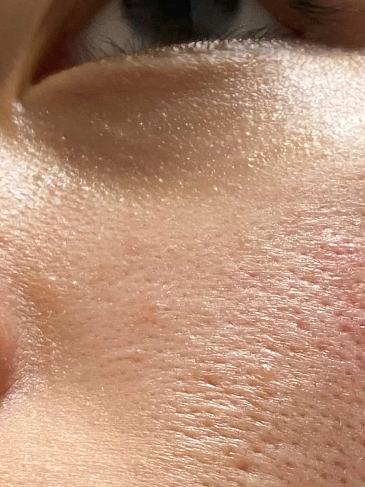 要想缩小毛孔让皮肤变得光滑,只能靠医美!