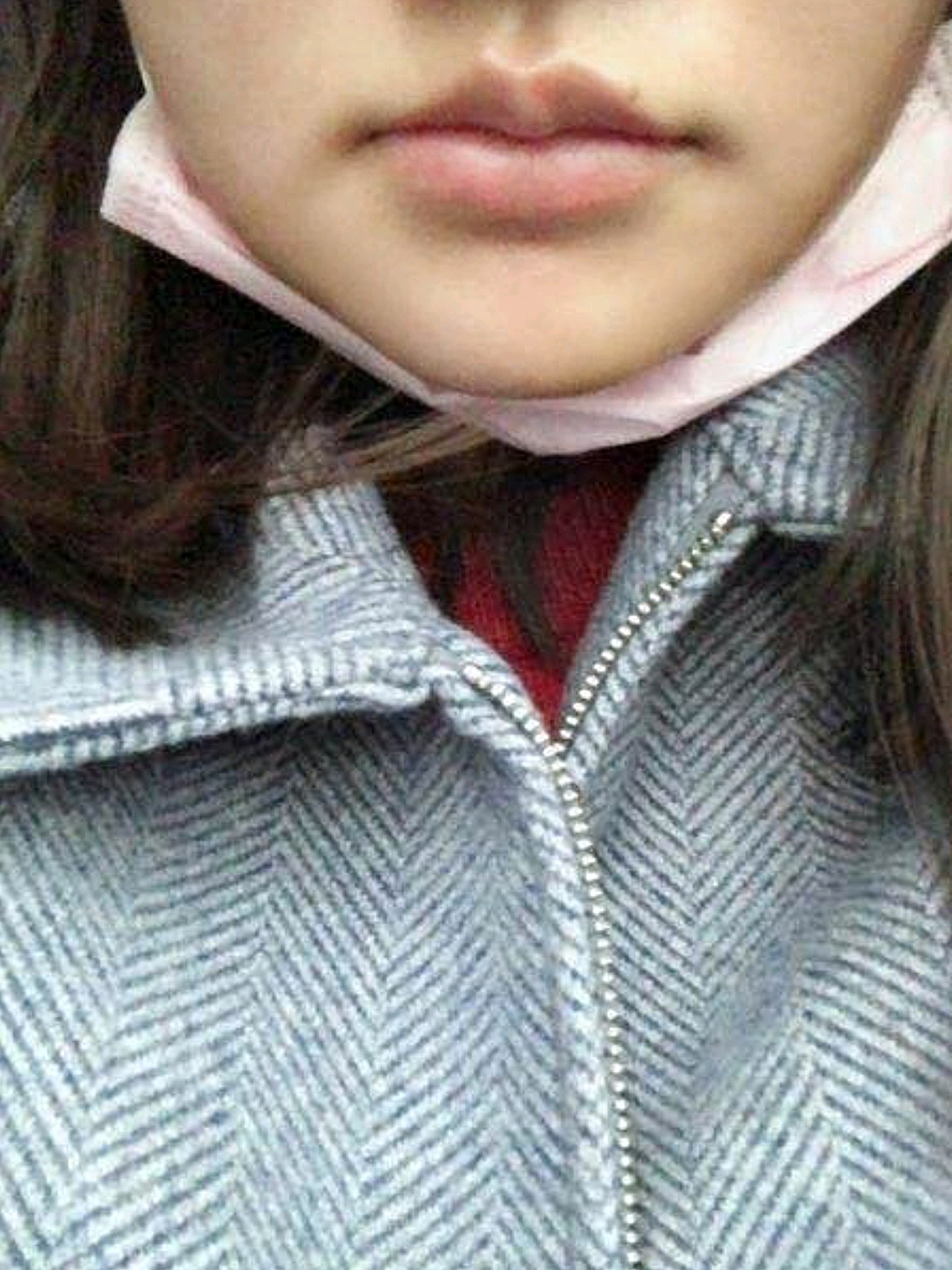 图一是刚取了纱布的时候,两边腮帮子都挺肿的,图二是_圈子-新氧美容