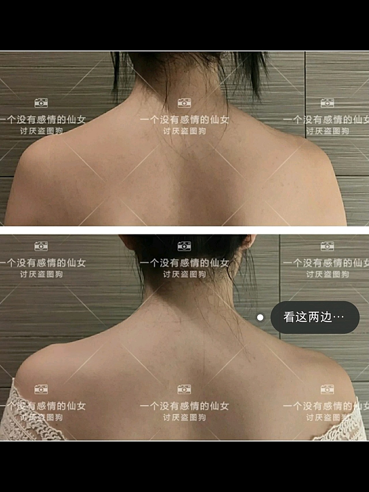 瘦肩针案例图片