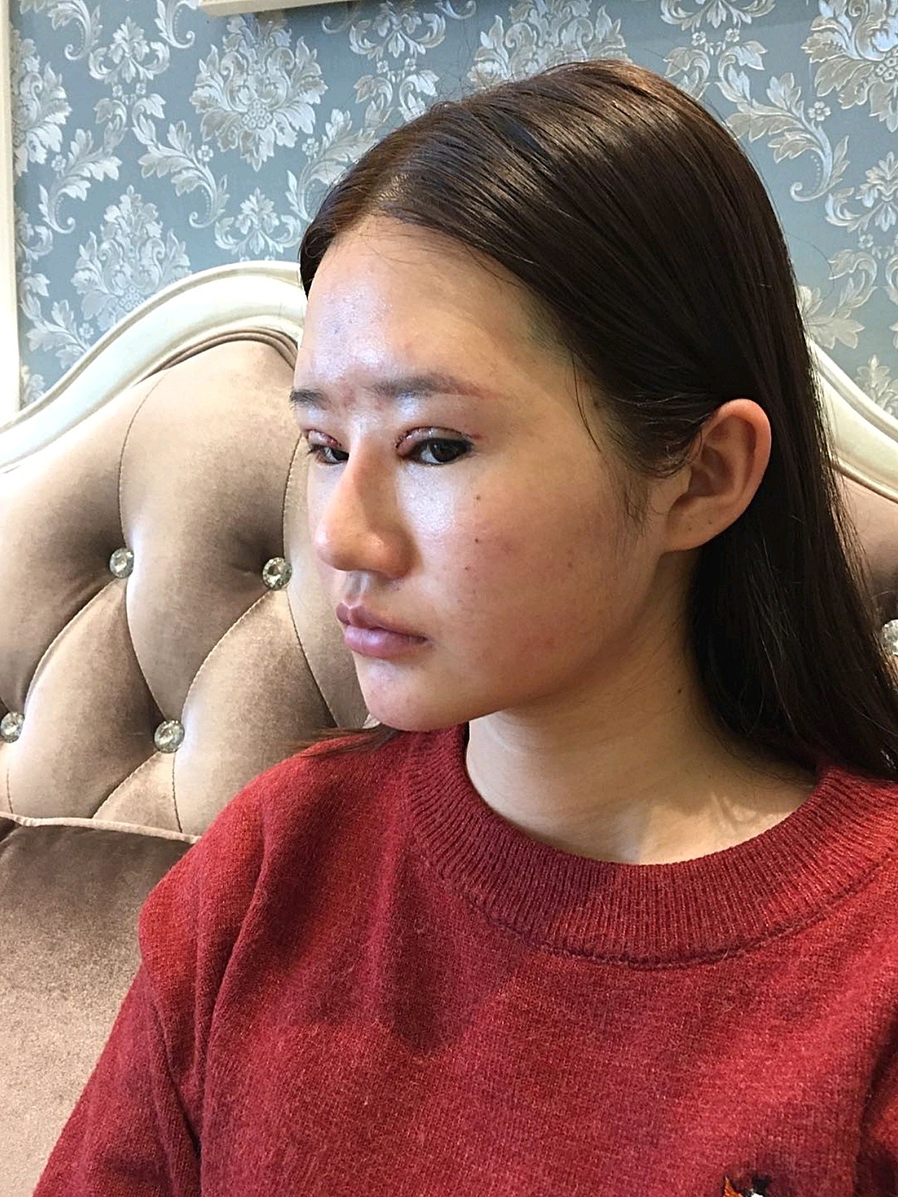 长期注射玻尿酸导致下巴都变形了,皮肤松弛吊起吊起的,这次来成都主要