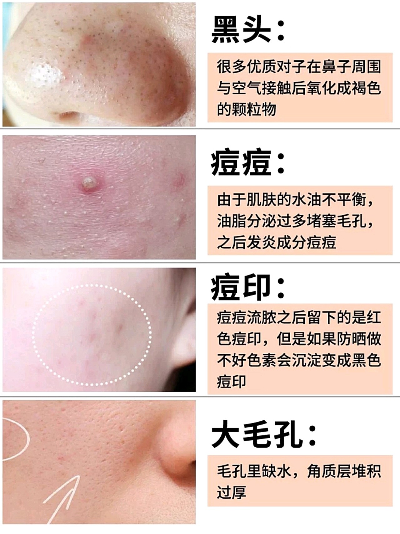 油脂的分泌旺盛71152_圈子-新氧美容整形